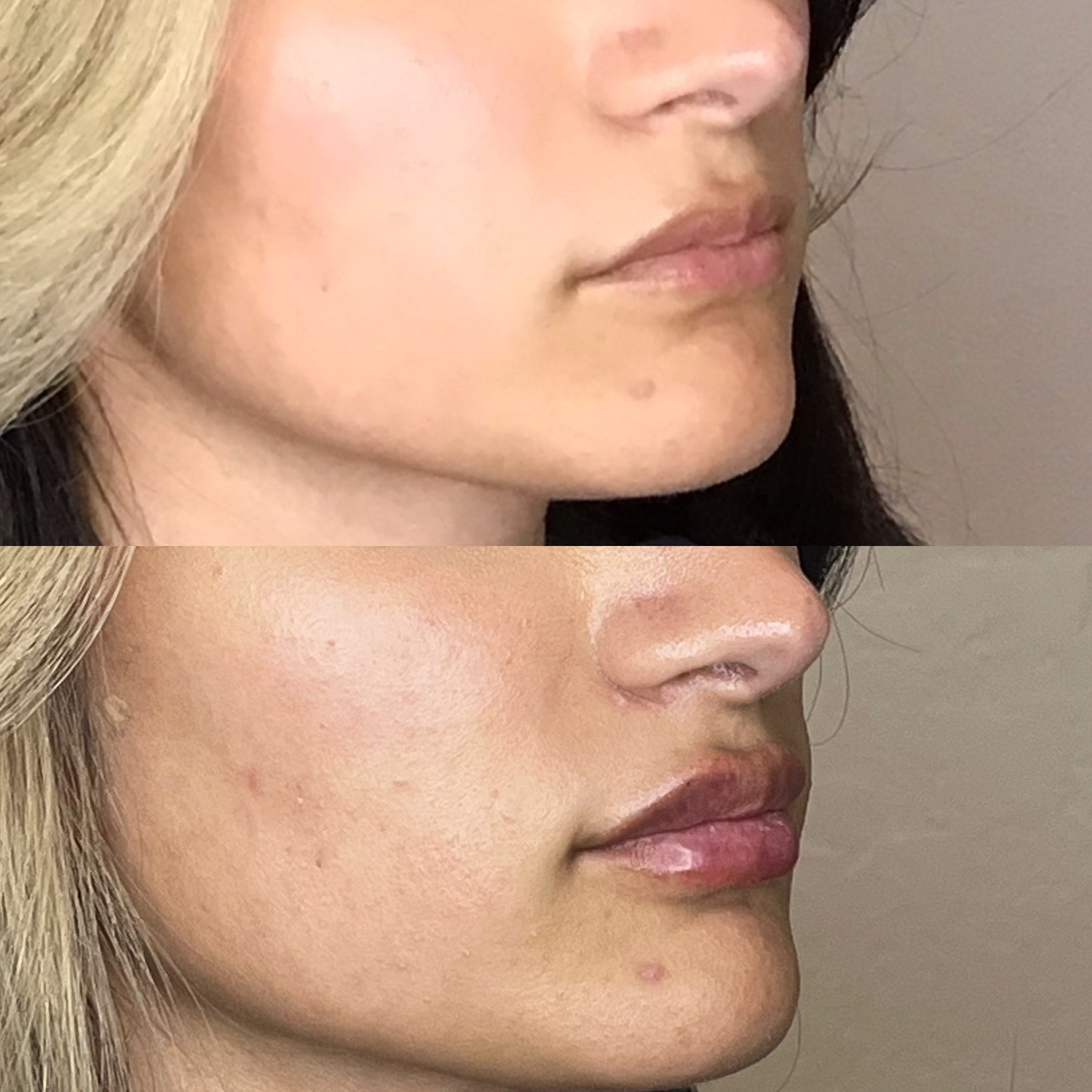 Before and after HA lip filler, three-quarter view, Desert Bloom Scottsdale