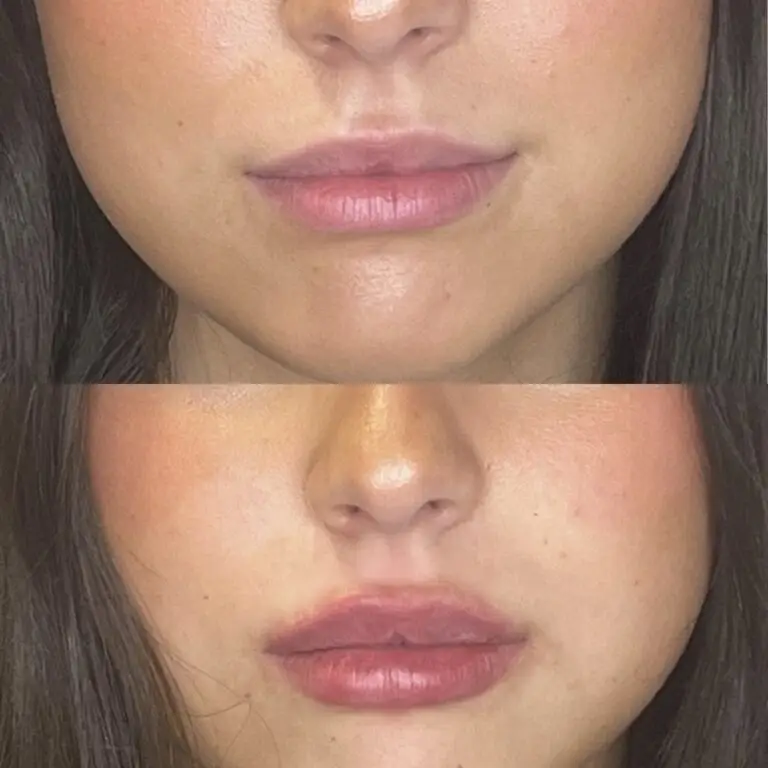 Desert Bloom patient — Lip filler result, case 10