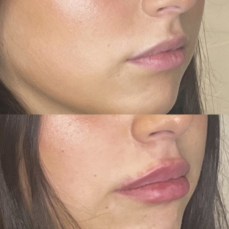 Desert Bloom patient — Lip filler result, case 11
