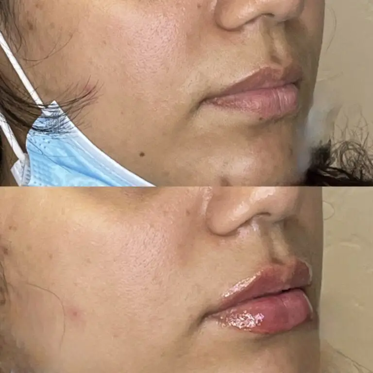 Desert Bloom patient — Lip filler result, case 12