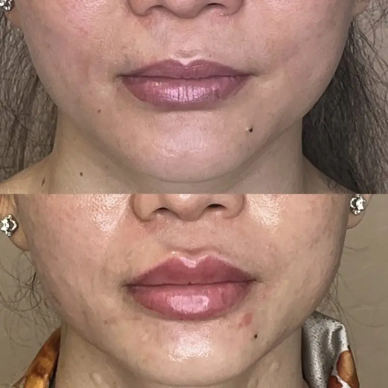 Desert Bloom patient — Lip filler result, case 13