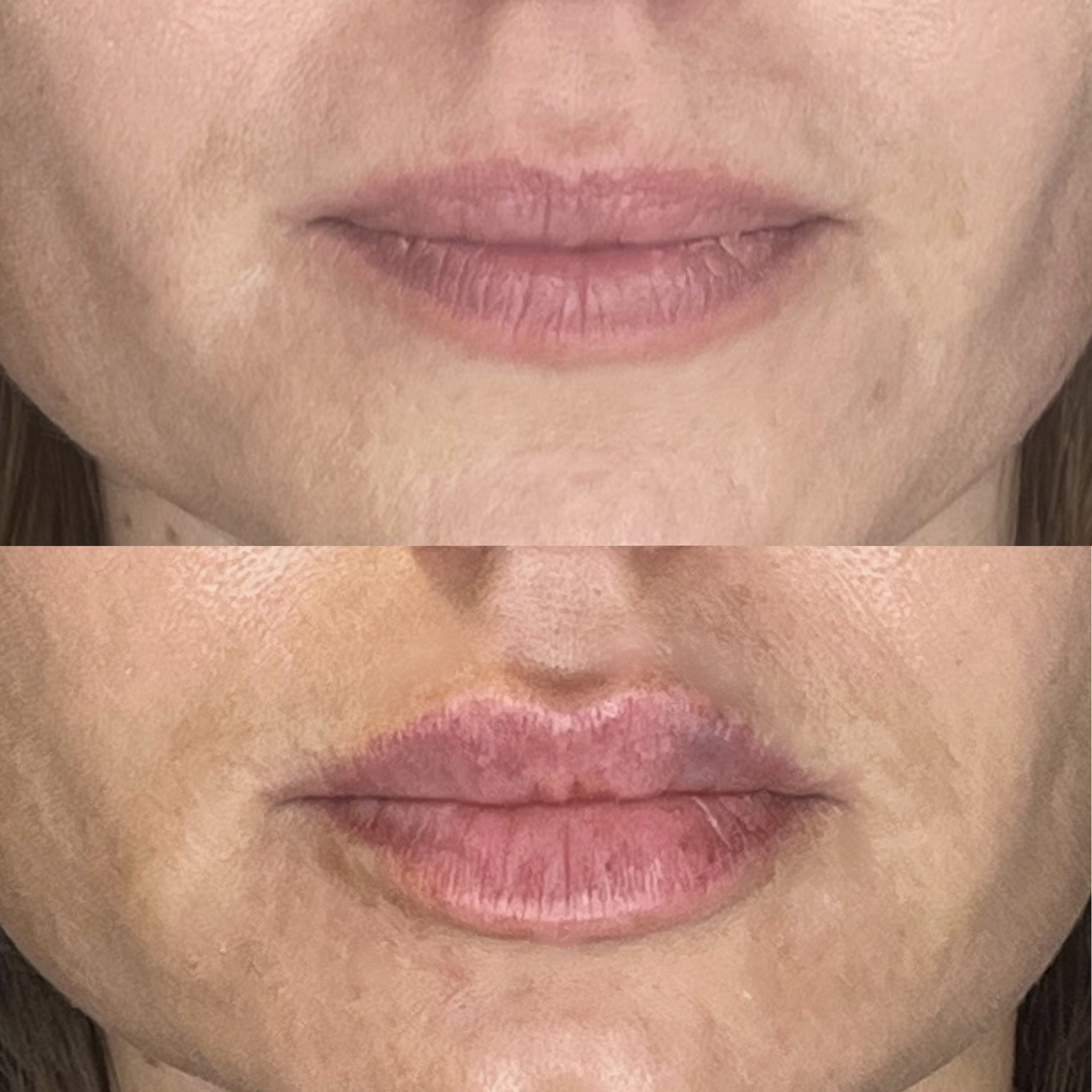 Before and after subtle lip filler enhancement, Desert Bloom Scottsdale