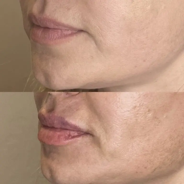 Desert Bloom patient — Lip filler result, case 15