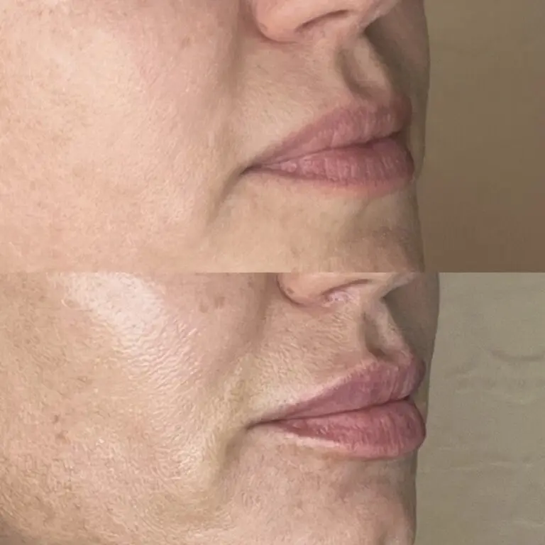 Desert Bloom patient — Lip filler result, case 16