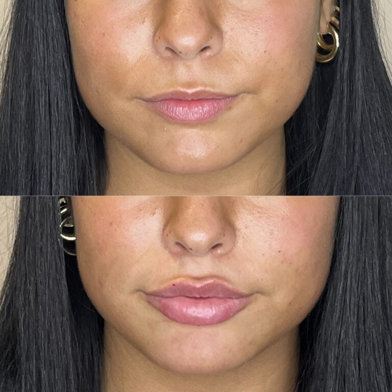 Desert Bloom patient — Lip filler result, case 17