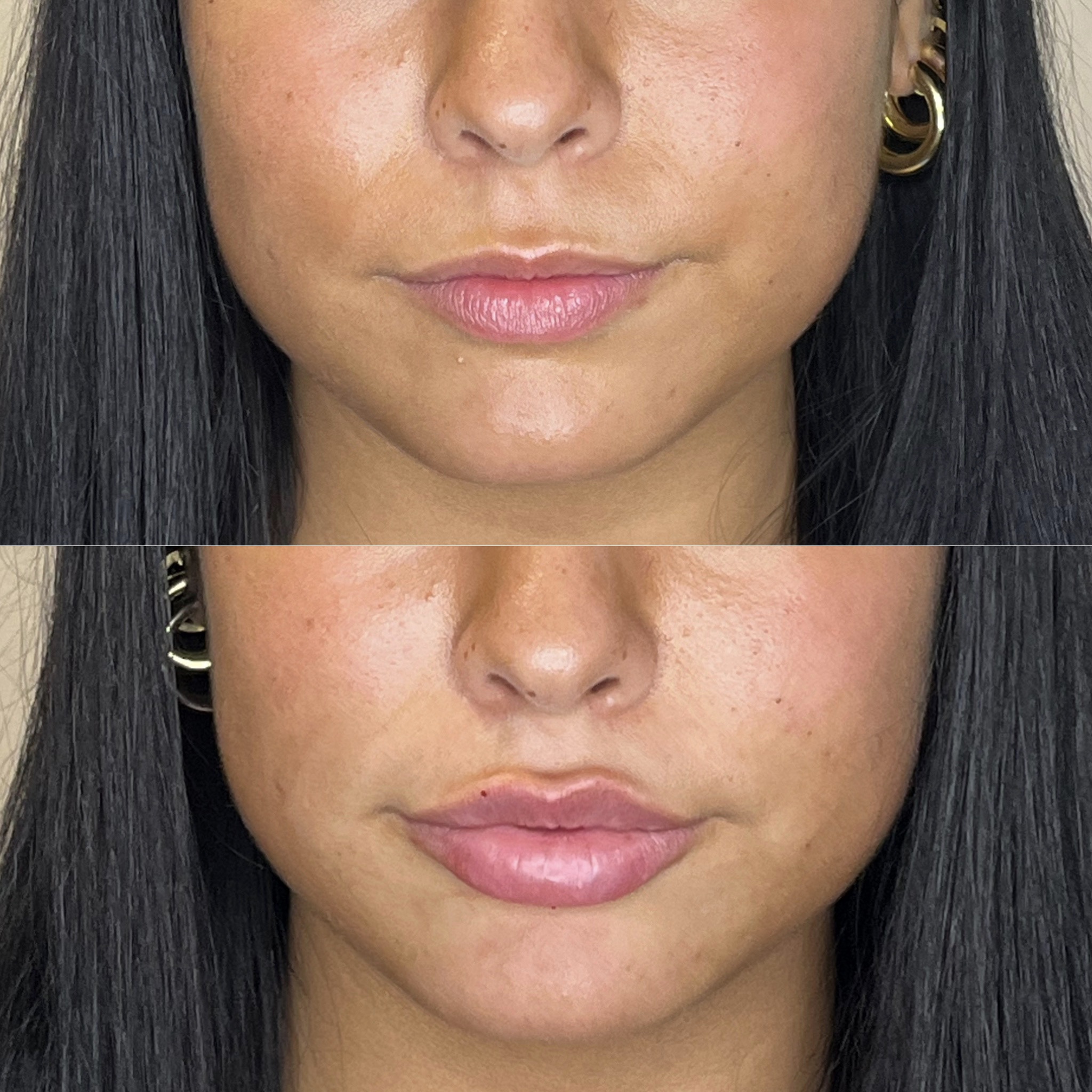 Before and after lip filler refining shape and projection, Desert Bloom Scottsdale