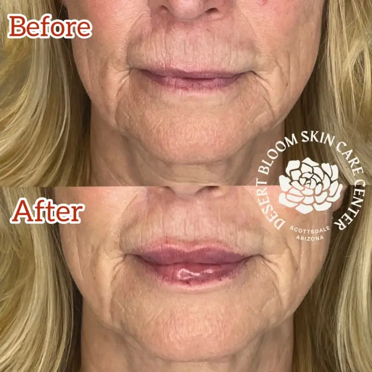 Desert Bloom patient — Lip filler result, case 18