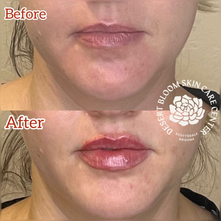 Desert Bloom patient — Lip filler result, case 19