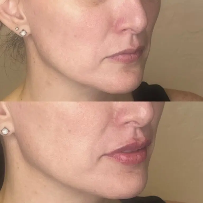 Desert Bloom patient — Lip filler result, case 2