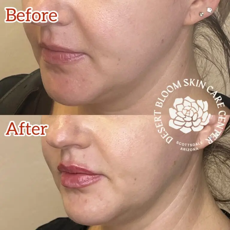 Desert Bloom patient — Lip filler result, case 20