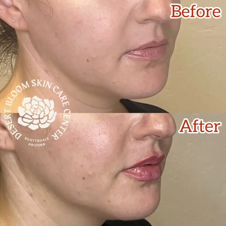 Desert Bloom patient — Lip filler result, case 21