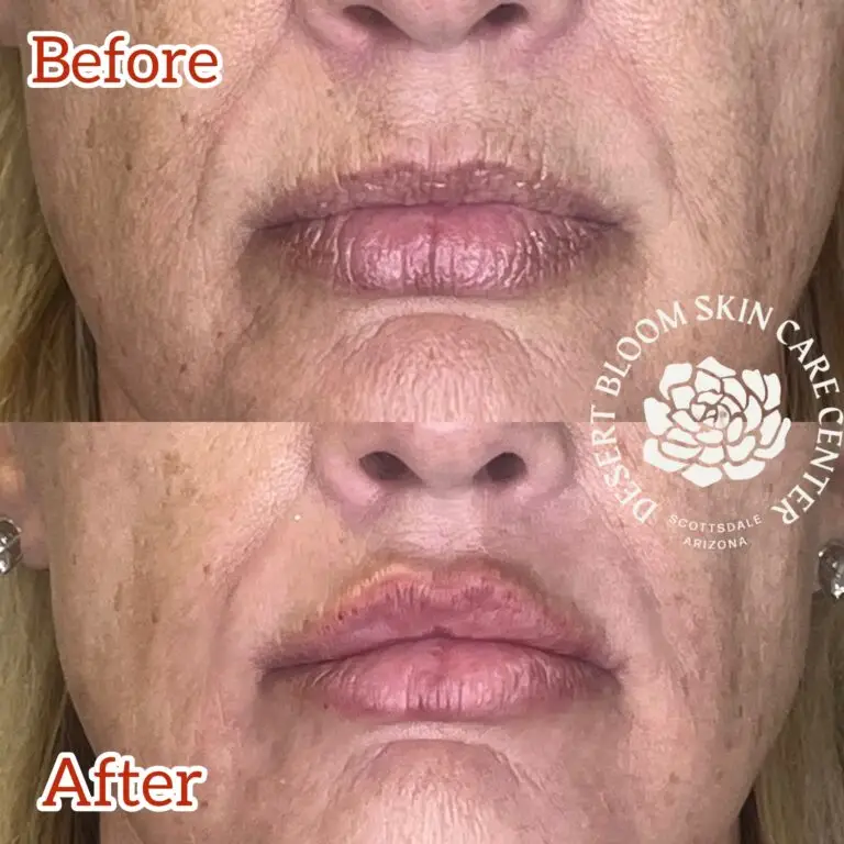 Desert Bloom patient — Lip filler result, case 22