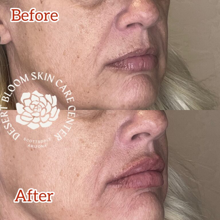 Desert Bloom patient — Lip filler result, case 23