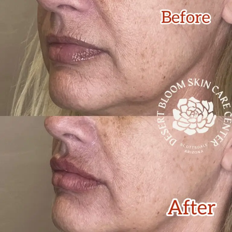 Desert Bloom patient — Lip filler result, case 24