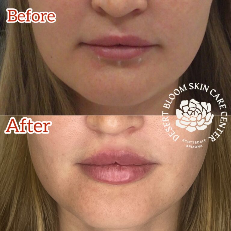 Desert Bloom patient — Lip filler result, case 25