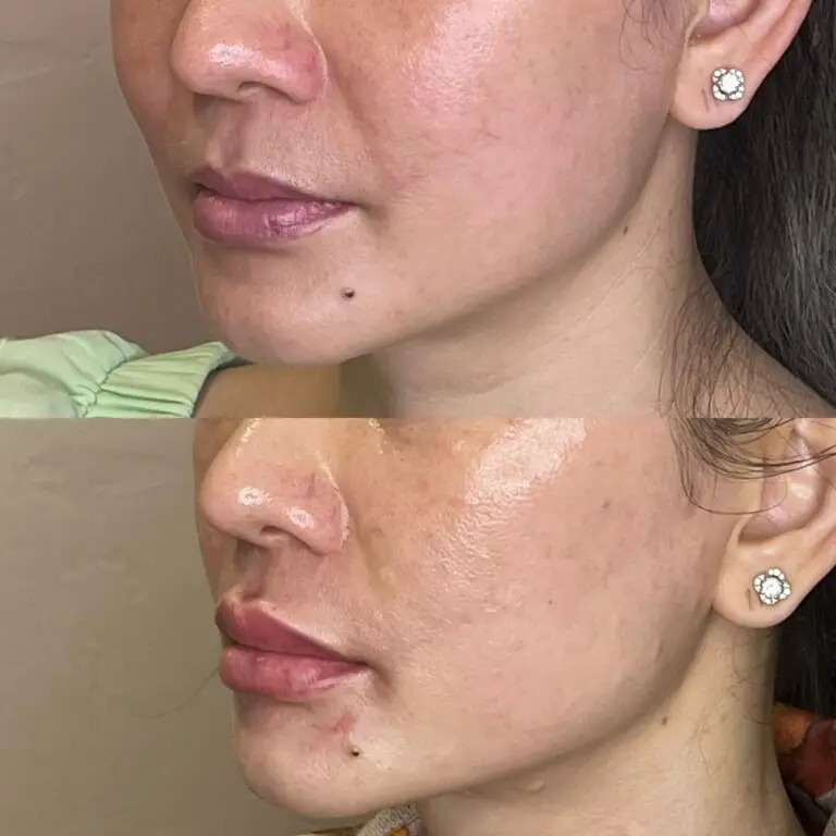 Desert Bloom patient — Lip filler result, case 3