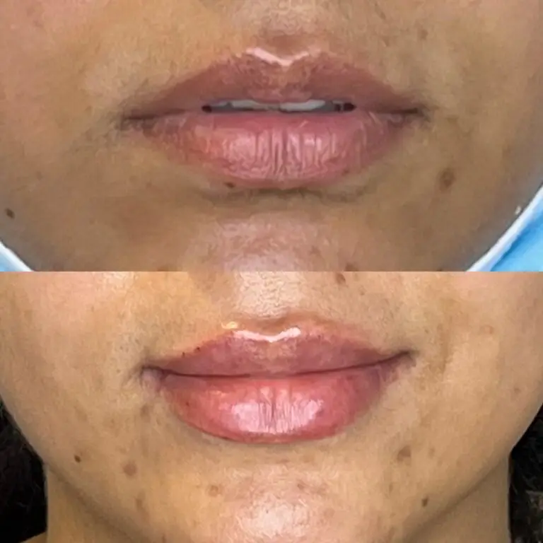 Desert Bloom patient — Lip filler result, case 4