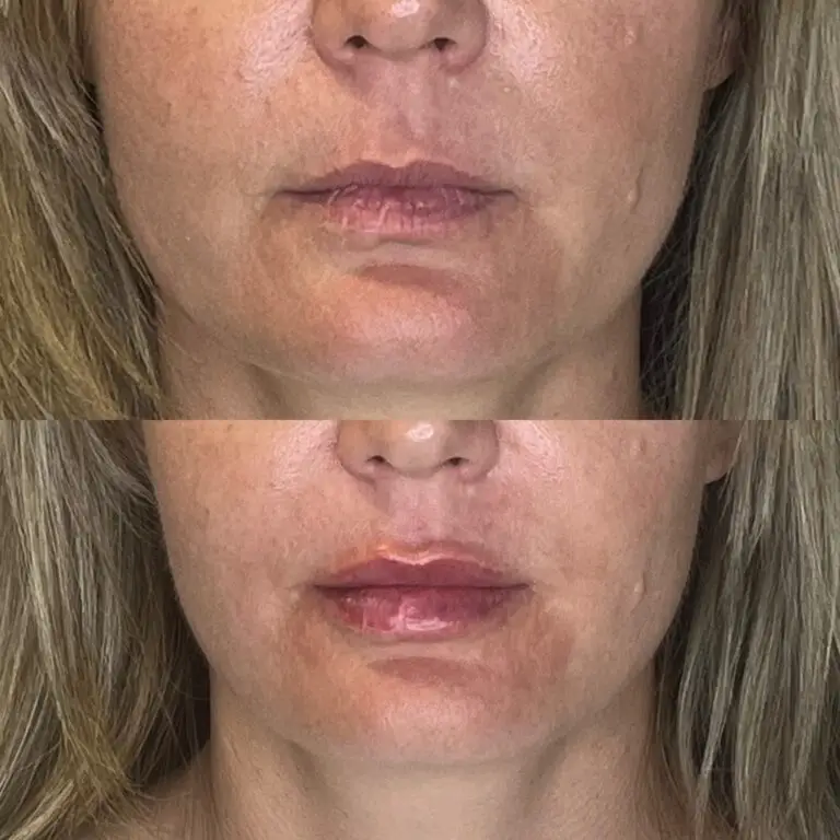 Desert Bloom patient — Lip filler result, case 5