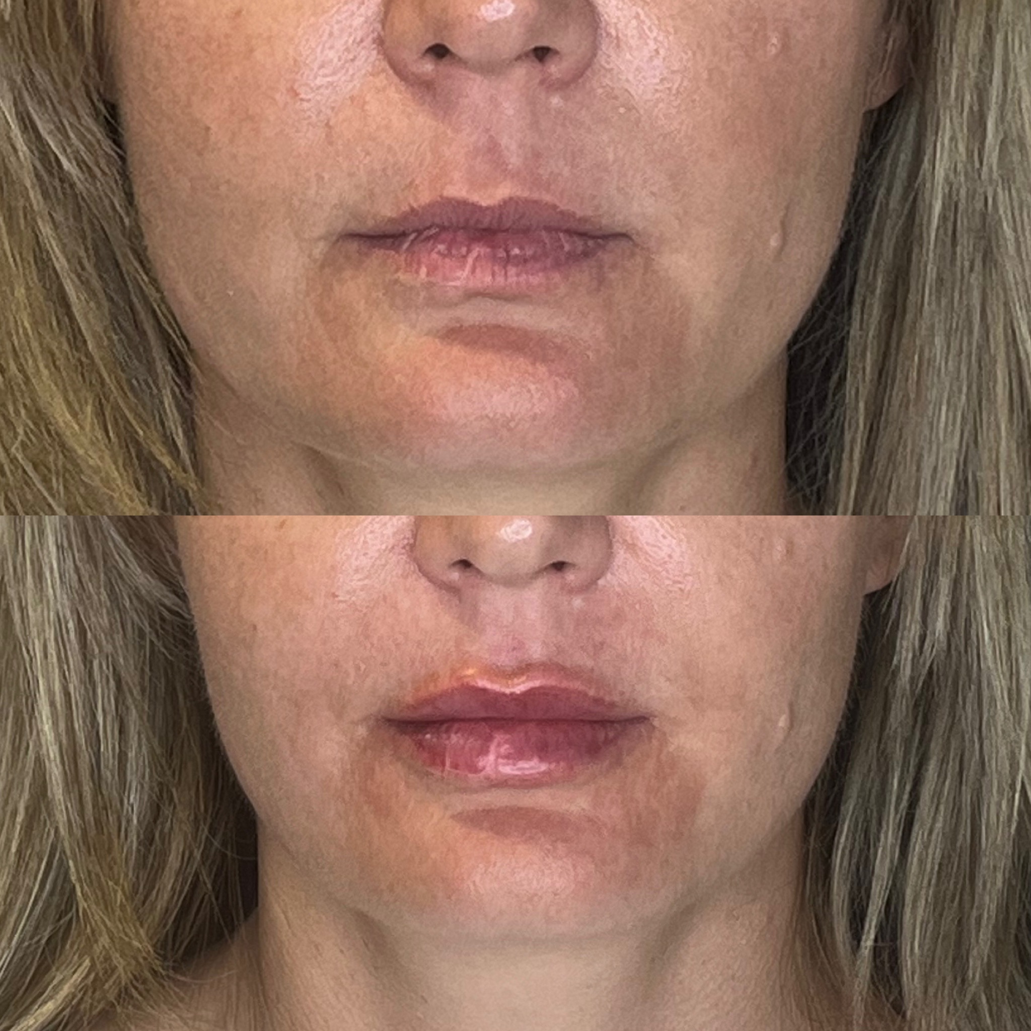 Before and after lip augmentation front view, Desert Bloom Scottsdale