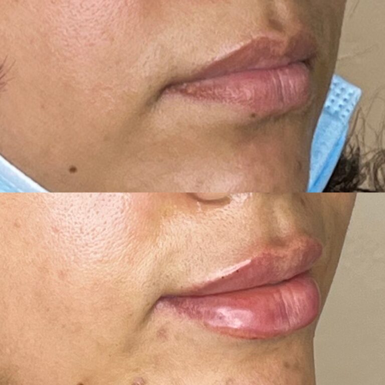 Desert Bloom patient — Lip filler result, case 6