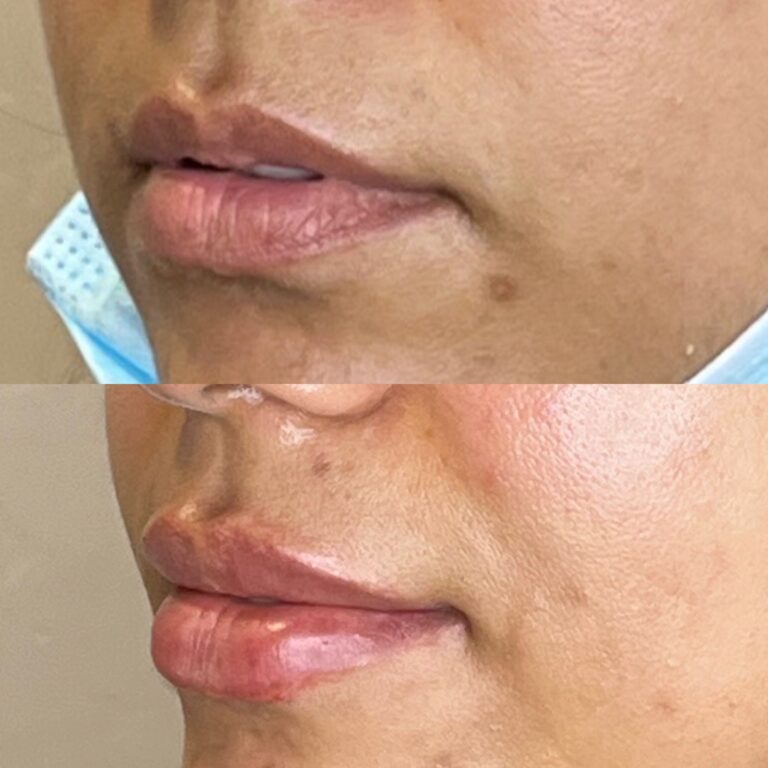 Desert Bloom patient — Lip filler result, case 7