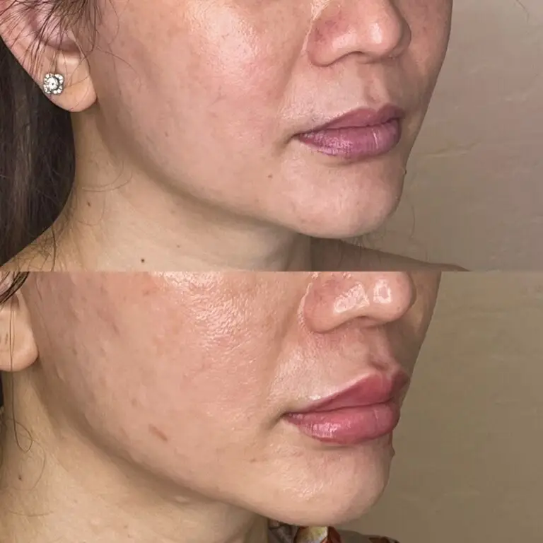 Desert Bloom patient — Lip filler result, case 8