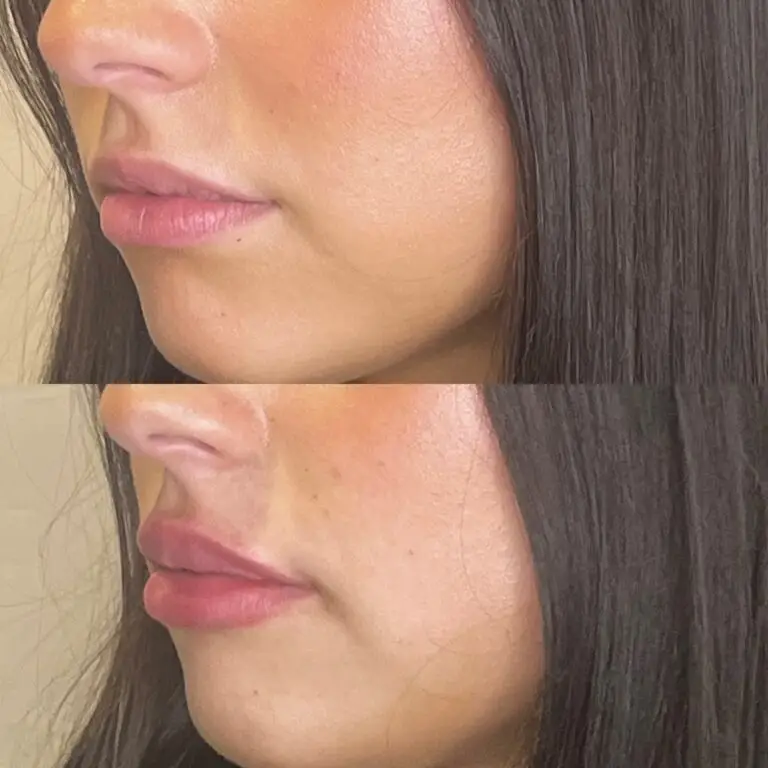 Desert Bloom patient — Lip filler result, case 9