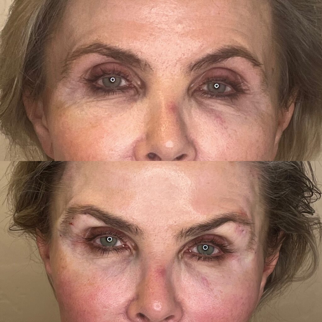 Non-Surgical Brow Lift result 2