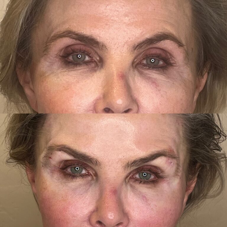 Desert Bloom patient — Non-surgical brow lift result, case 1