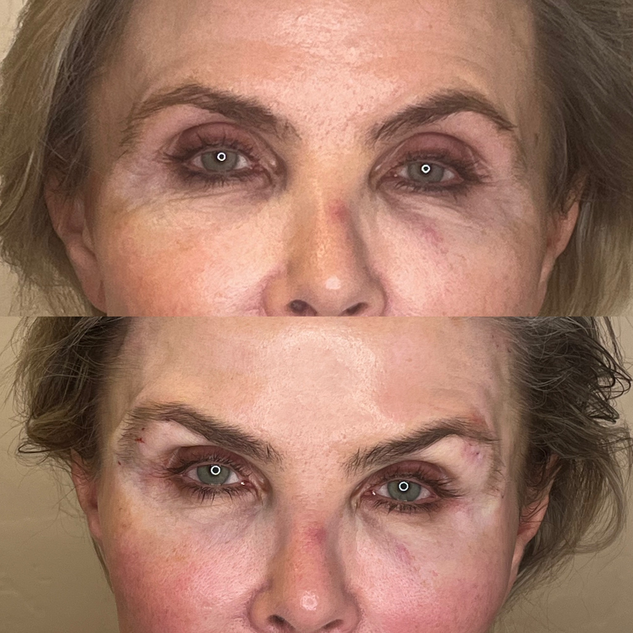 Before and after non-surgical thread brow lift, frontal view