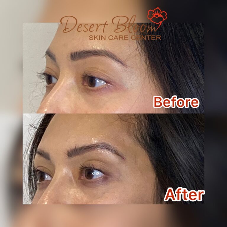 Desert Bloom patient — Non-surgical brow lift result, case 10