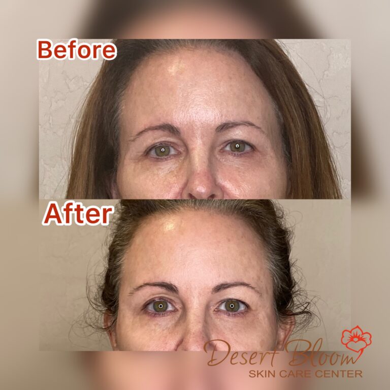 Desert Bloom patient — Non-surgical brow lift result, case 11