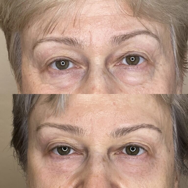 Desert Bloom patient — Non-surgical brow lift result, case 12