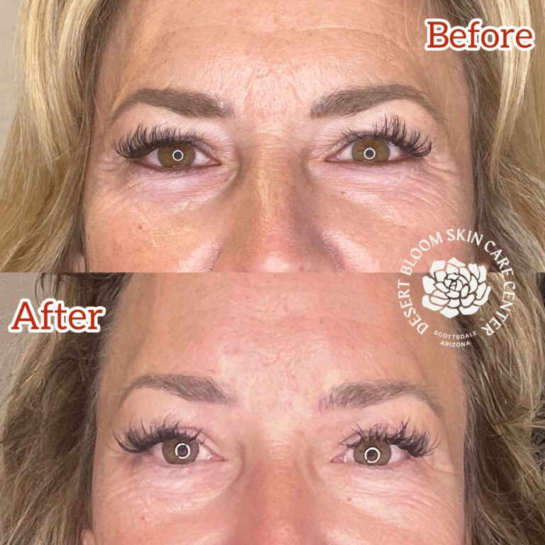 Desert Bloom patient — Non-surgical brow lift result, case 13