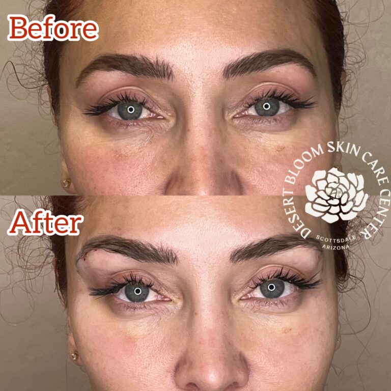 Desert Bloom patient — Non-surgical brow lift result, case 14