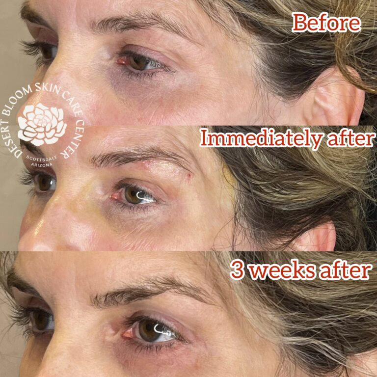 Desert Bloom patient — Non-surgical brow lift result, case 15