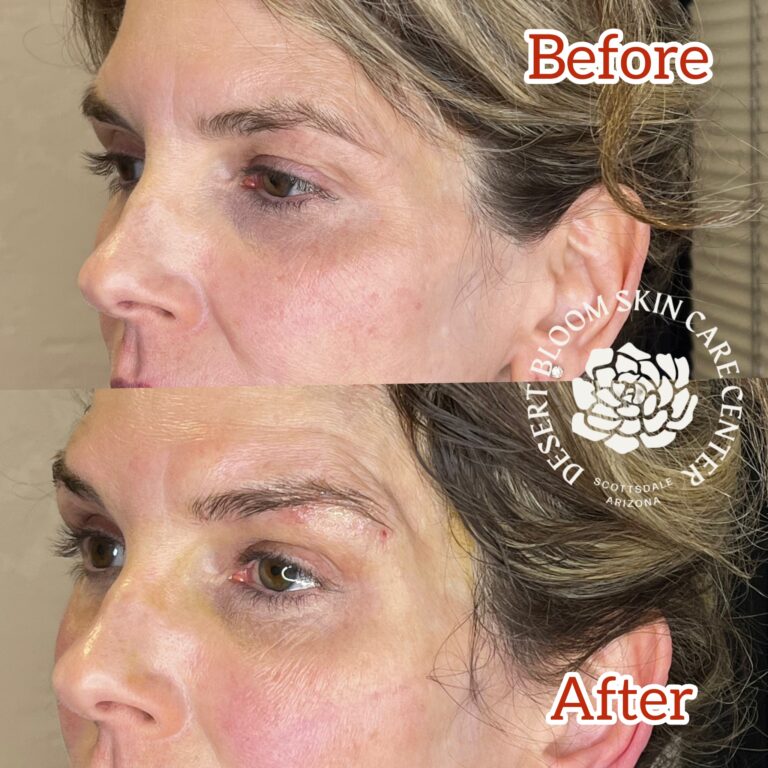 Desert Bloom patient — Non-surgical brow lift result, case 16