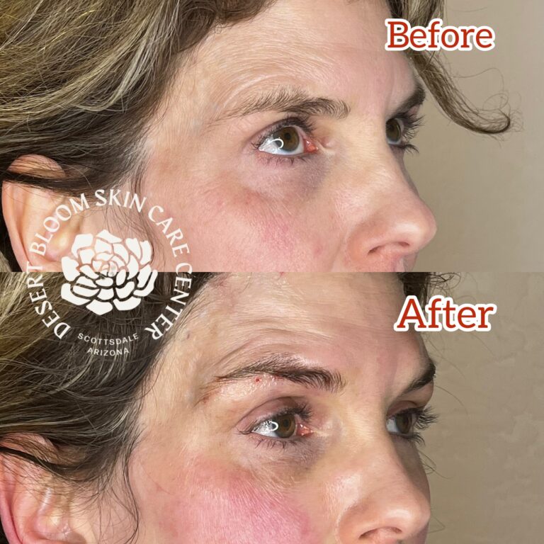 Desert Bloom patient — Non-surgical brow lift result, case 17