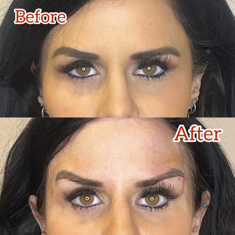 Desert Bloom patient — Non-surgical brow lift result, case 18