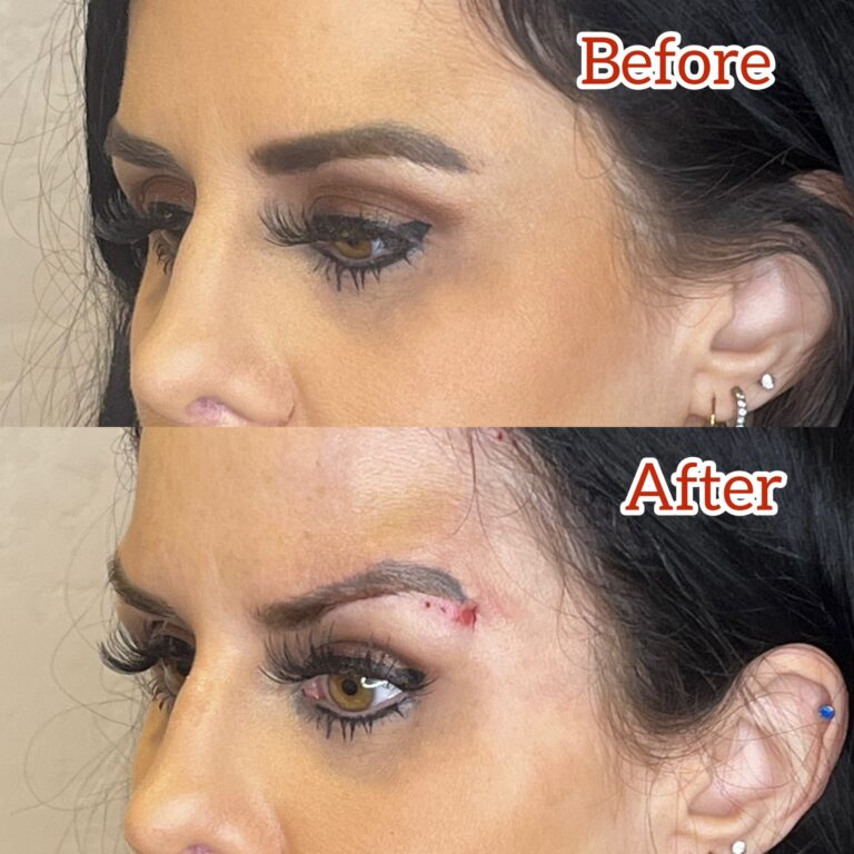 Desert Bloom patient — Non-surgical brow lift result, case 19