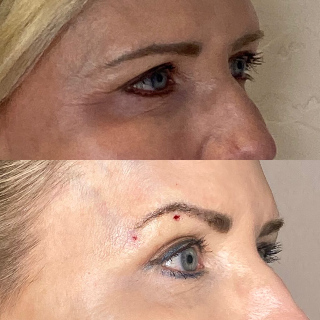 Non-Surgical Brow Lift result 3