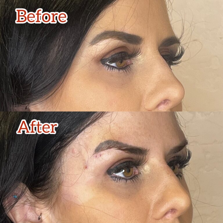Desert Bloom patient — Non-surgical brow lift result, case 20