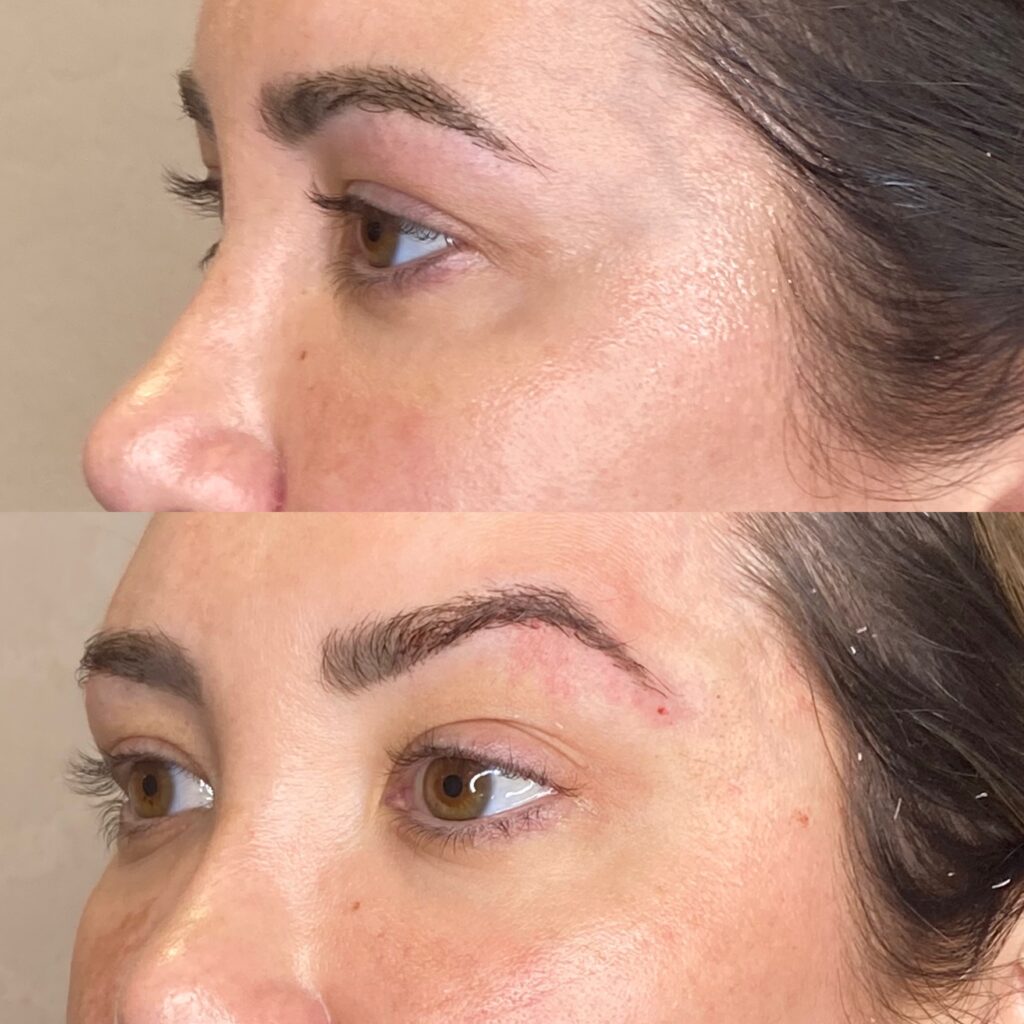 Non-Surgical Brow Lift result 4