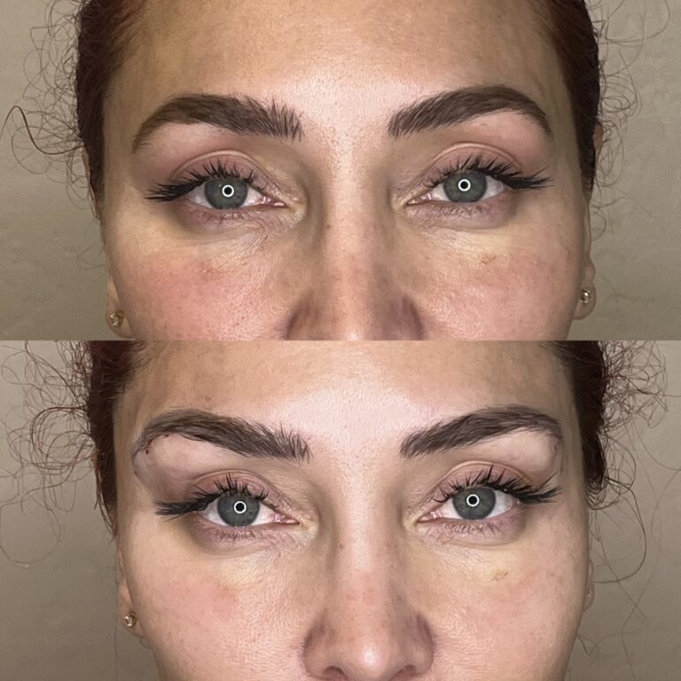 Desert Bloom patient — Non-surgical brow lift result, case 7