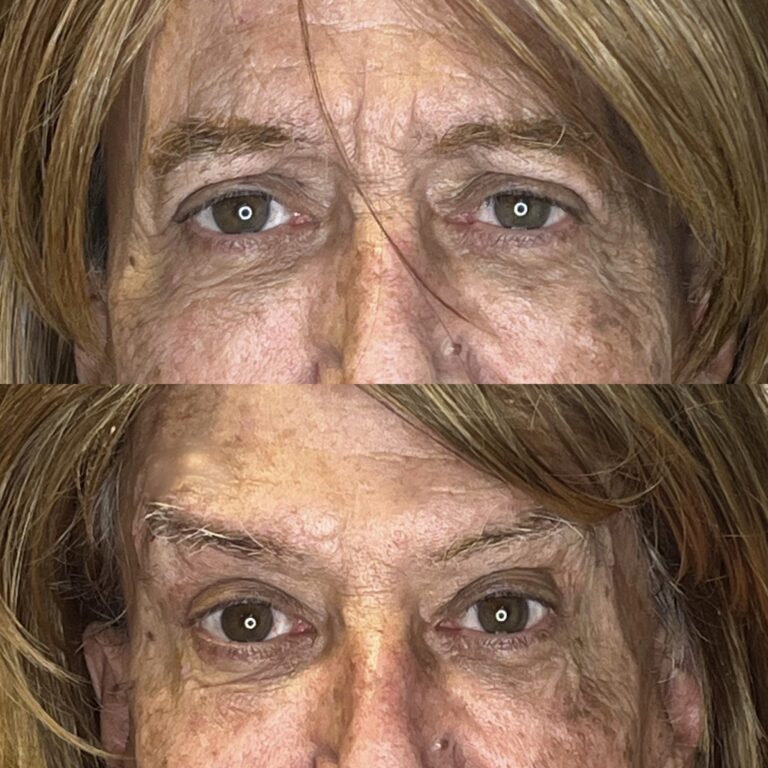 Desert Bloom patient — Non-surgical brow lift result, case 8