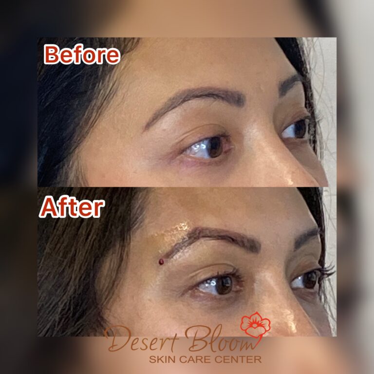 Desert Bloom patient — Non-surgical brow lift result, case 9