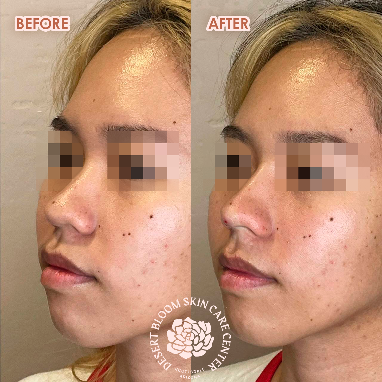 Before and after Asian nose bridge and projection enhancement with PDO threads, full face view