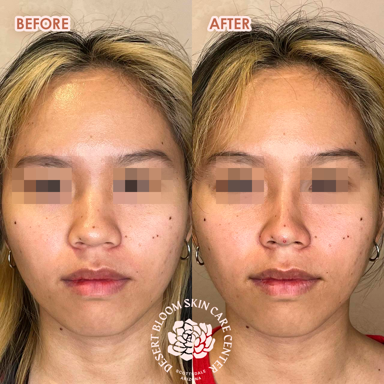 Before and after Asian nose bridge enhancement with PDO threads, front view