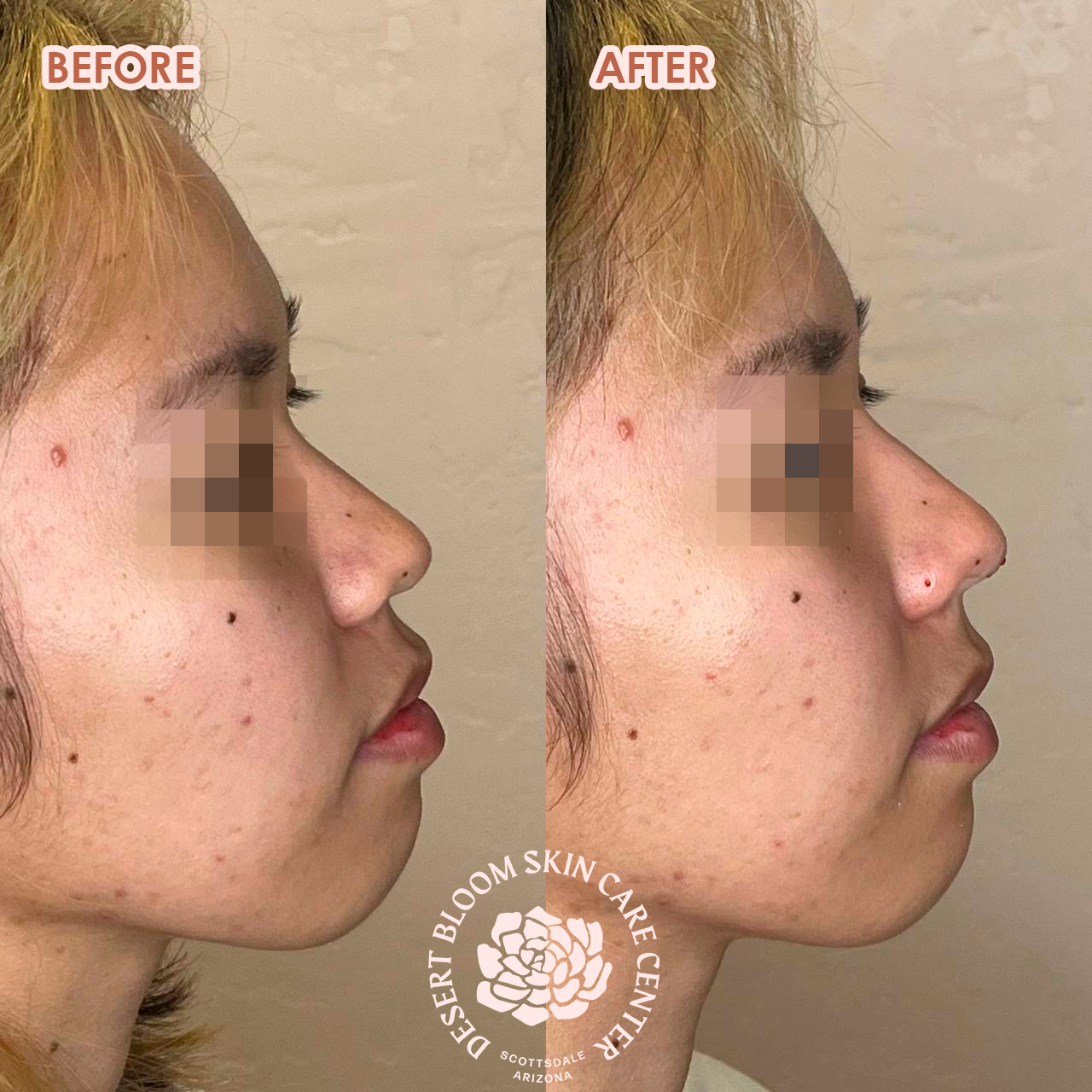 Before and after Asian nose bridge enhancement with PDO threads, left profile