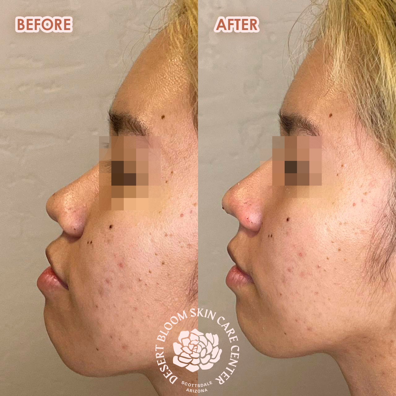 Before and after Asian nose bridge enhancement with PDO threads, right profile